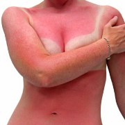 Sunburn related image